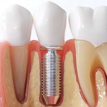 Costa & García Clínica Dental implante dental1
